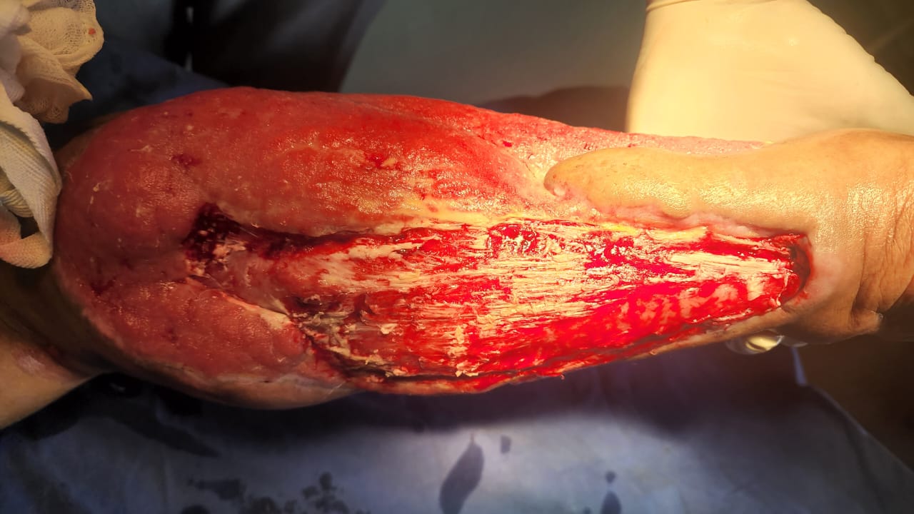 split skin grafting in Mandi HP